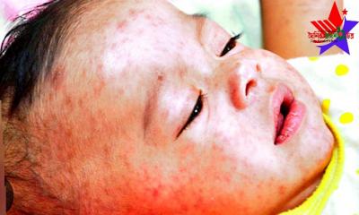 কুষ্টিয়ায় হামের প্রাদুর্ভাব উদ্বেগজনক হারে বাড়ছে: দেড় মাসে৭৭৪ জনের উপসর্গ শনাক্ত